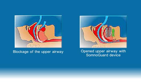 Sleep Apnea Treatment