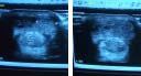 The Ultrasound Scans From Before and After 6 VET-2 Sonotron Treatments Were Compared To Determine If There Is Healing Of SDF Tendon Of Racehorse