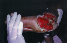 Non-healing diabetic ulcer